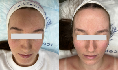 Пировиноградный пилинг